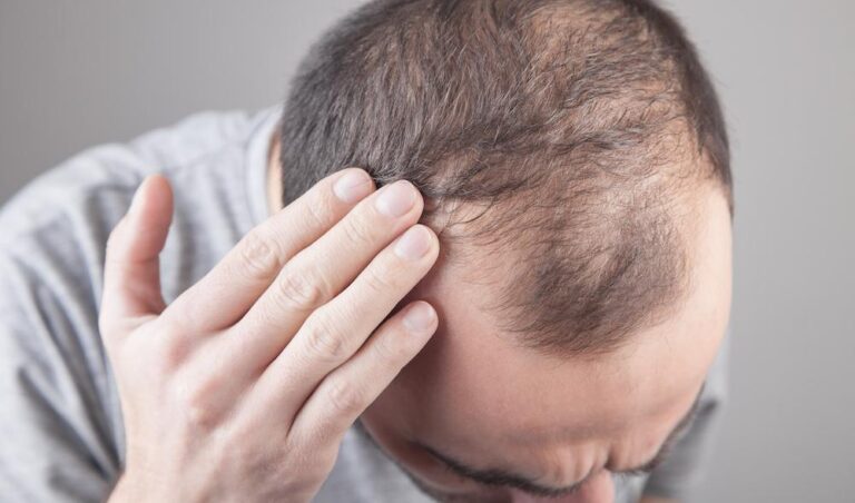 頭皮護理方法和落髮該怎麼辦?