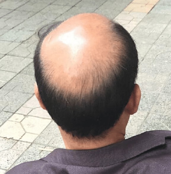 頭皮護理方法和落髮該怎麼辦?